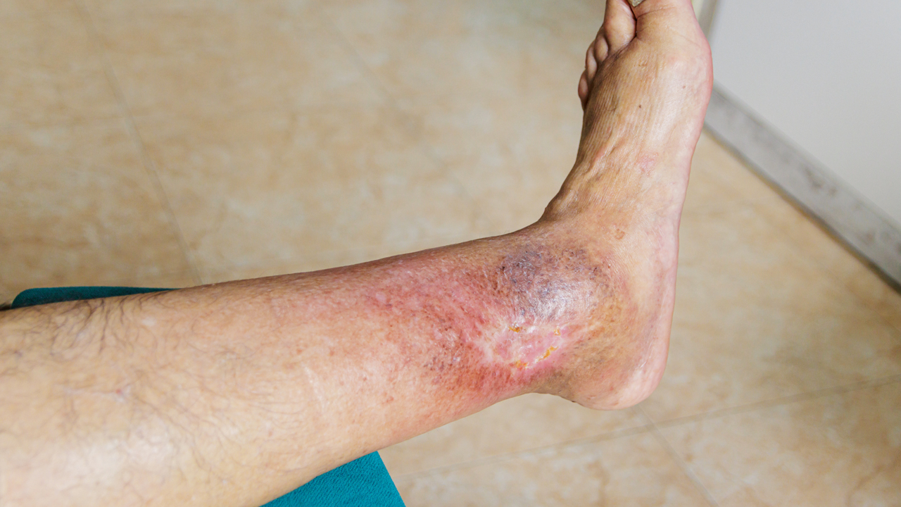 ulcer-main