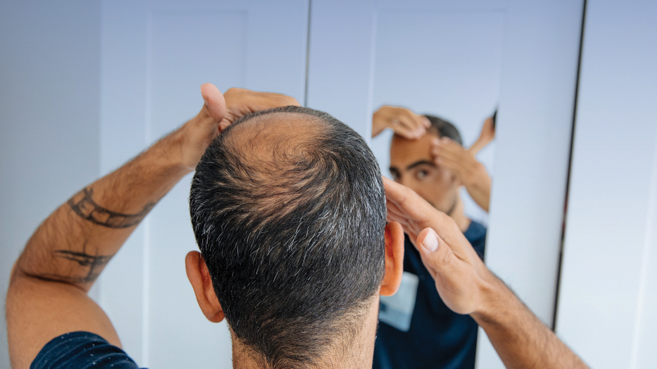 hair-loss