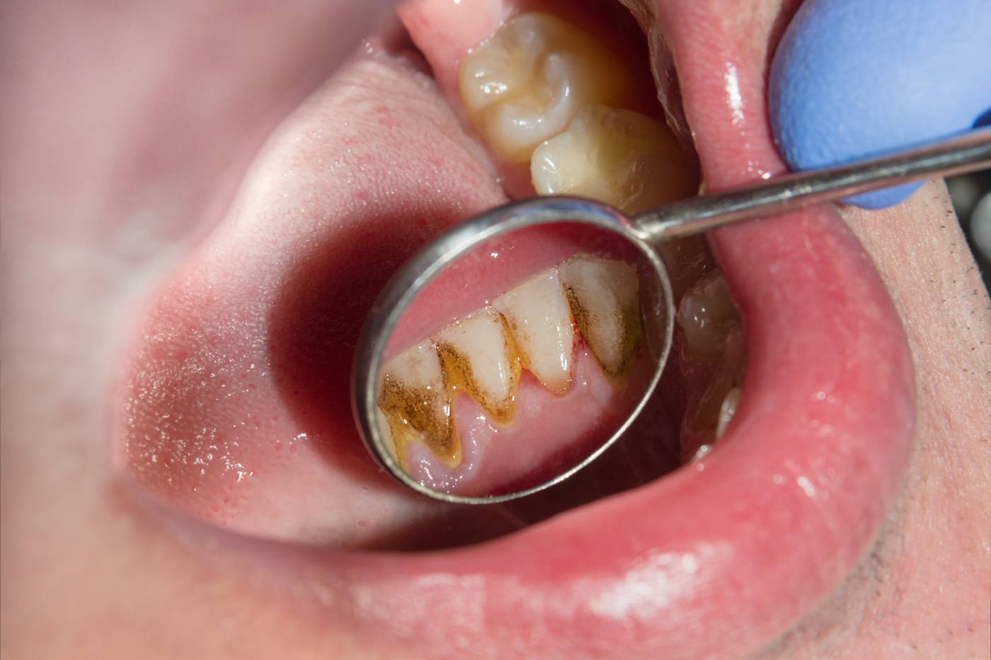 dental-plaque