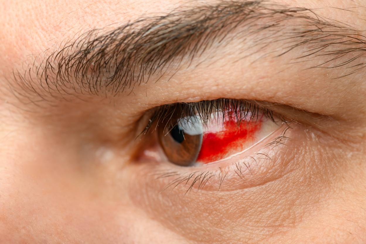 eye-burst-vessel-blood-leaking-into-eyeball-haemorrhage-mans-face