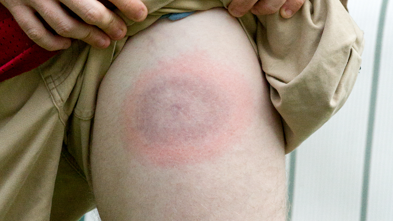 lyme-disease1-summary