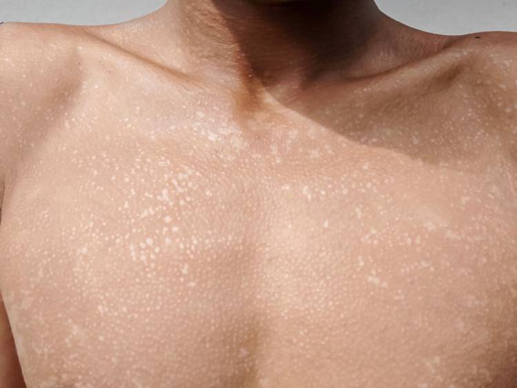 tinea-versicolour-1