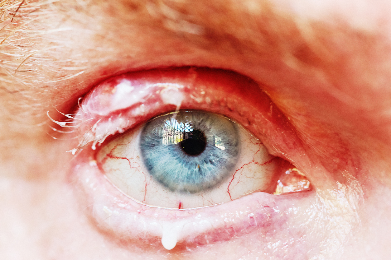 infected-eye